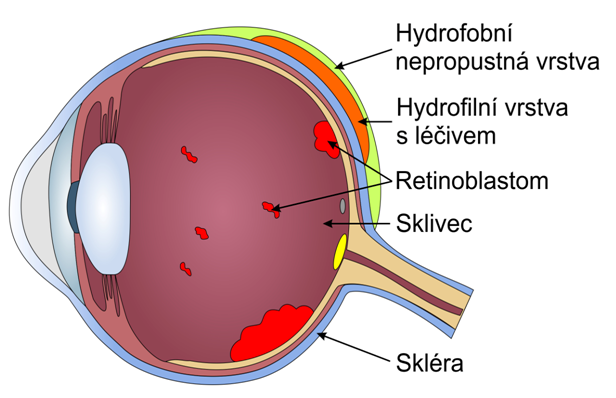 Nové způsoby aplikace protinádorových léčiv při léčbě očního zhoubného nádoru - retinoblastomu
