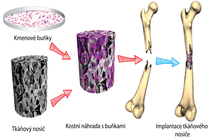 Uhlíkové kostní náhrady nové generace