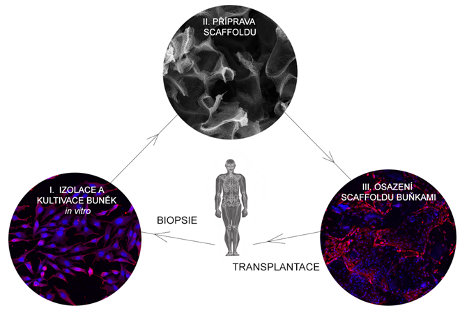 Uhlíkové kostní náhrady nové generace